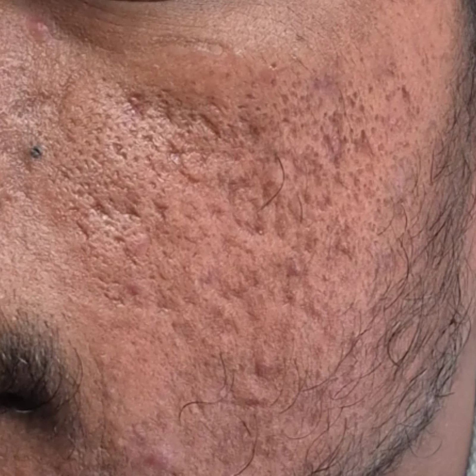 Acne Scar Treatment Patient 2 Before