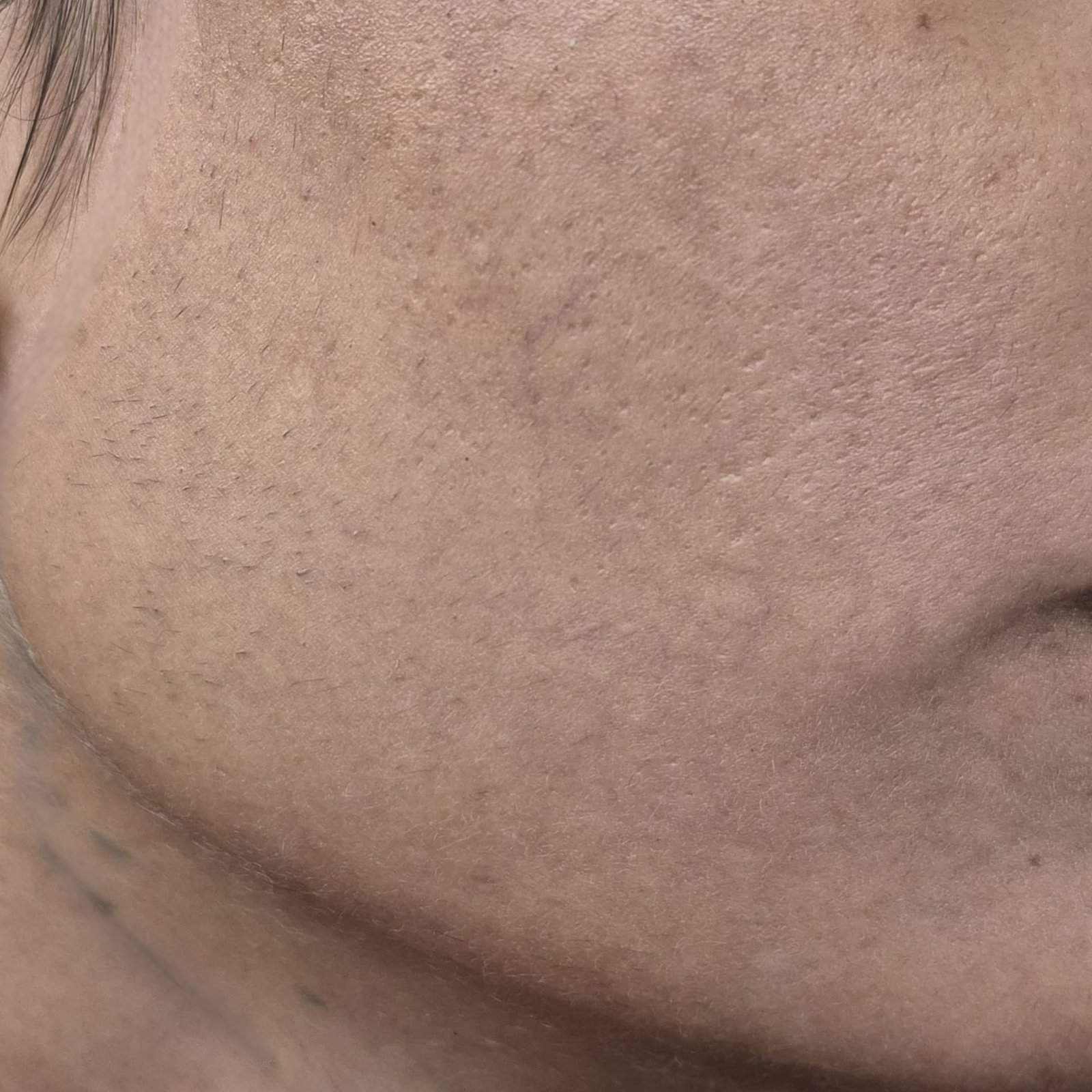 Laser Hair Removal Before