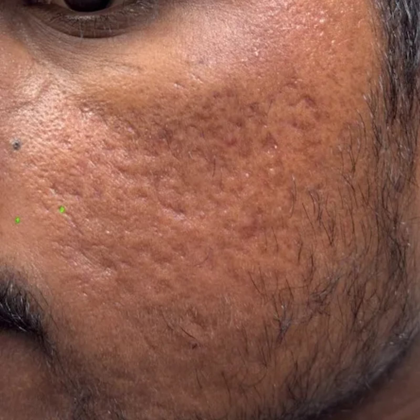 Acne Scar Treatment Patient 2 After