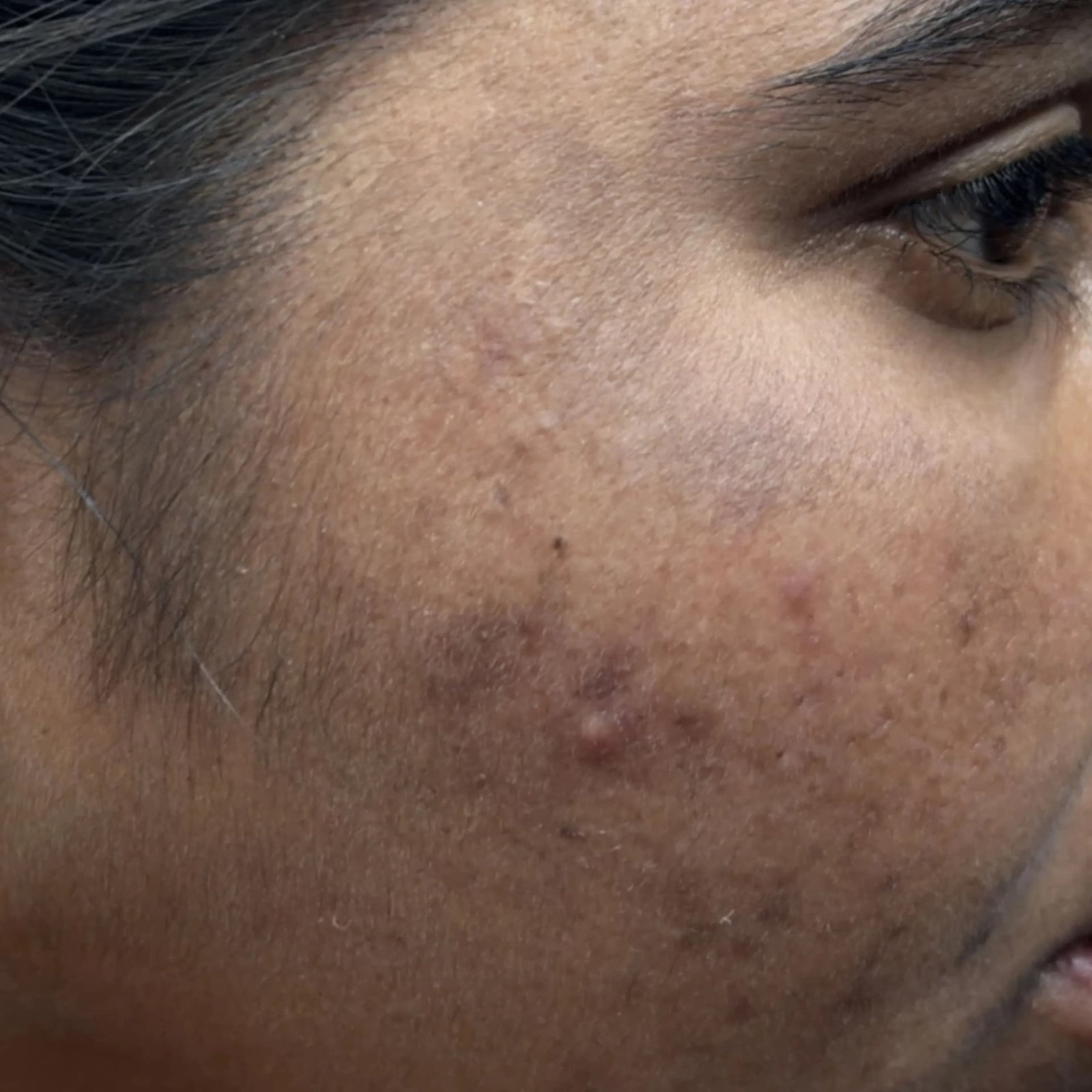 Pigmentation Patient 3 After