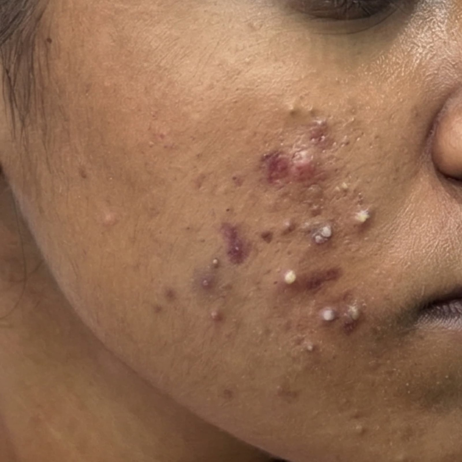 Active Acne Before