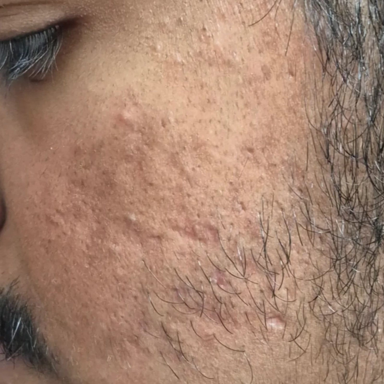 Acne Treatment Patient 3 Before
