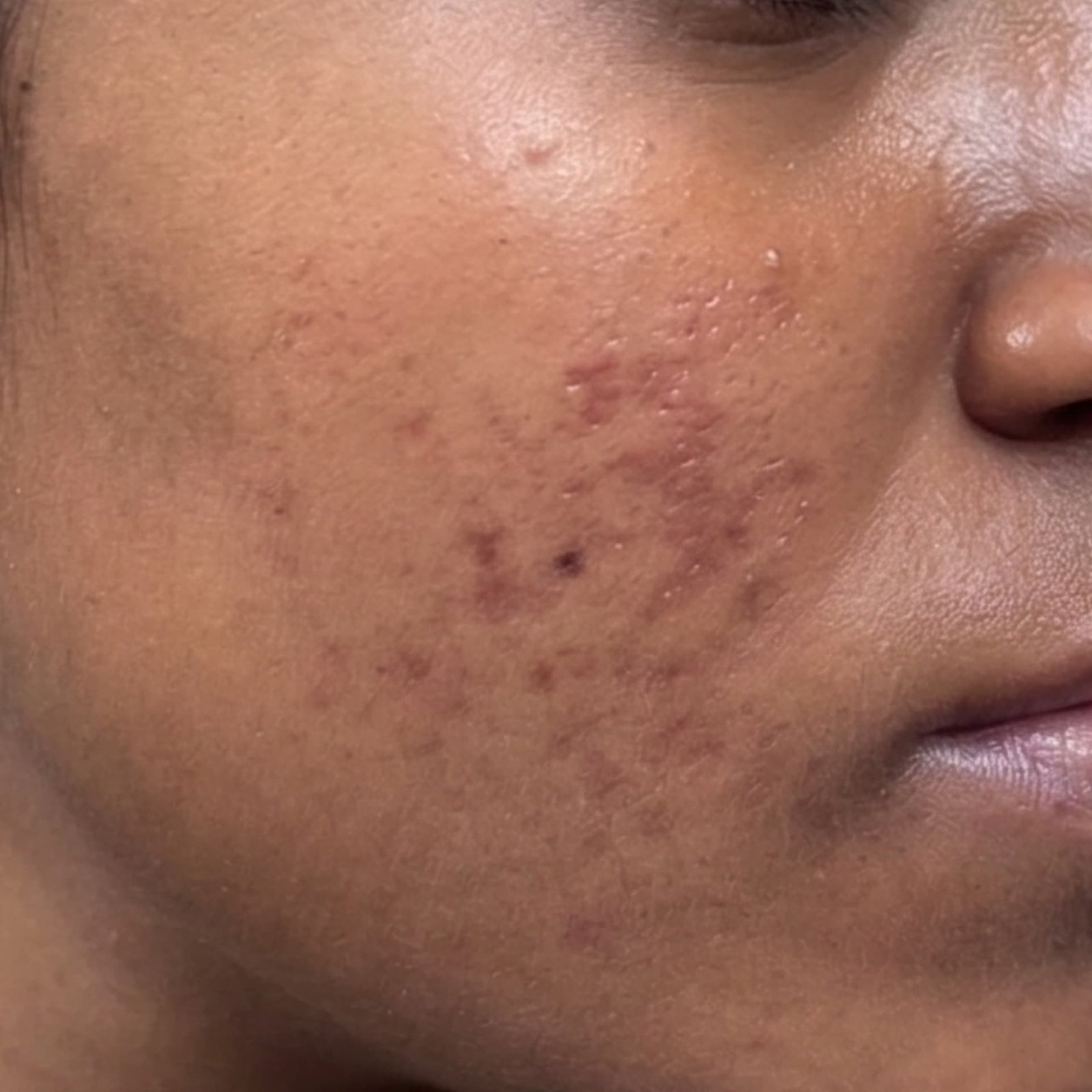 Active Acne After