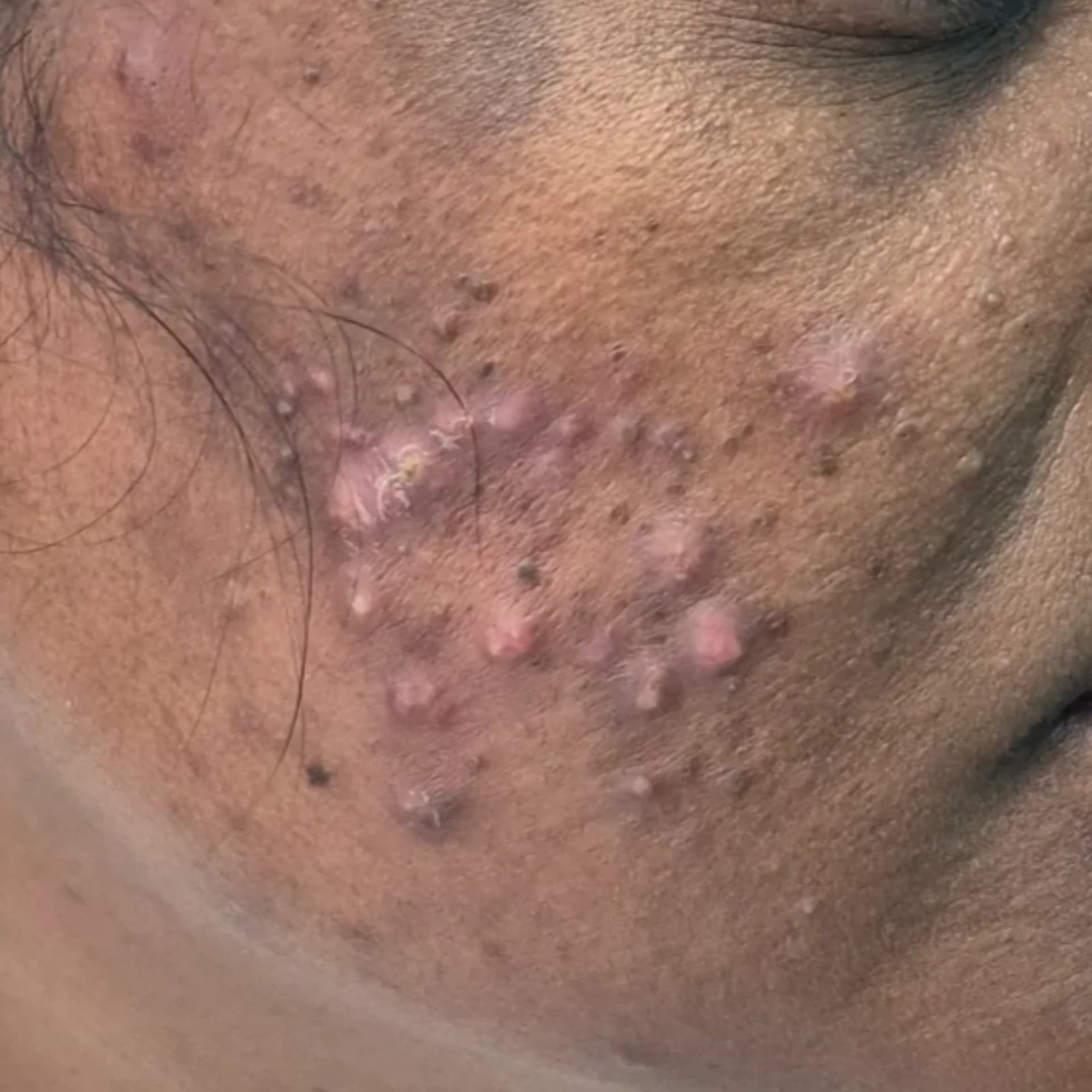 Acne Treatment Patient 2 Before