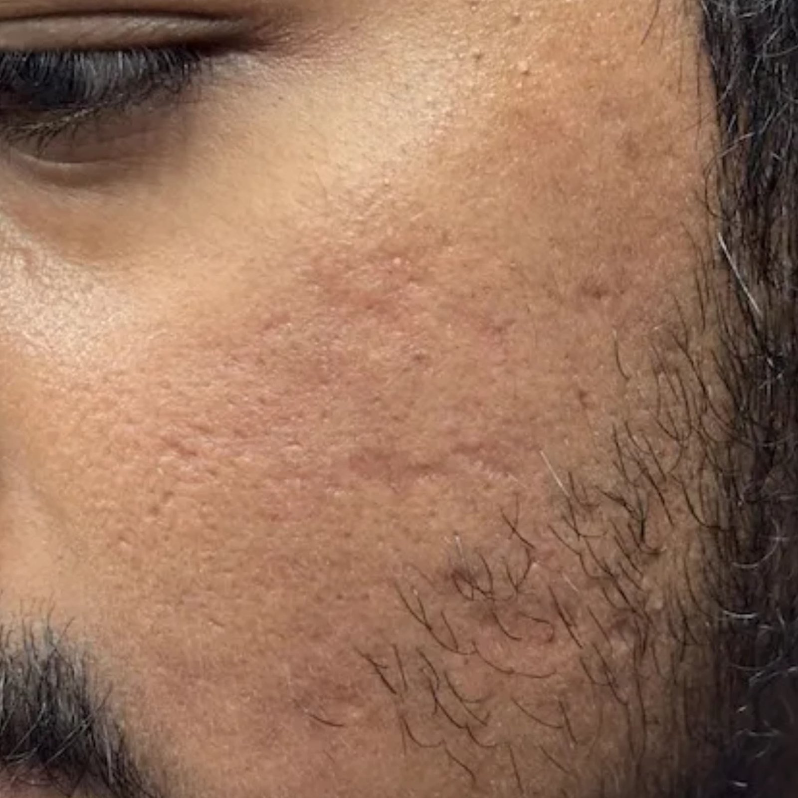Acne Treatment Patient 3 After