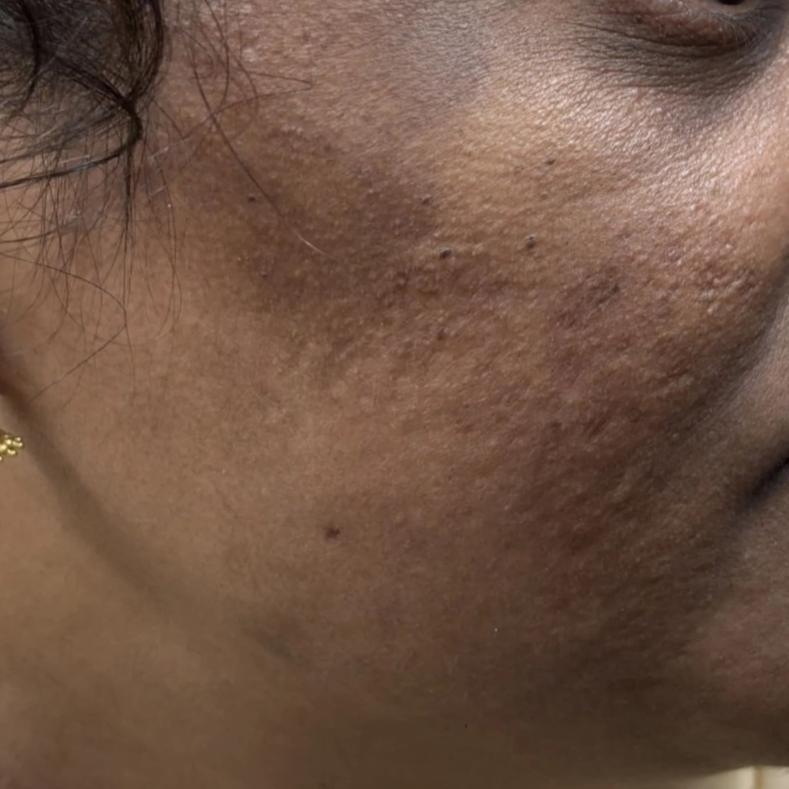 Acne Treatment Patient 2 After