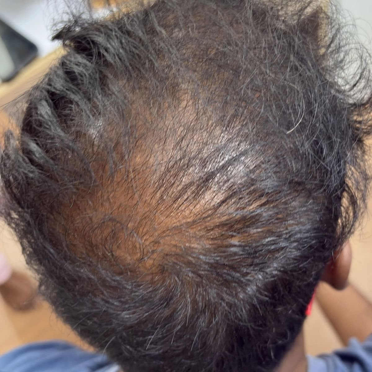 Hair Loss Before