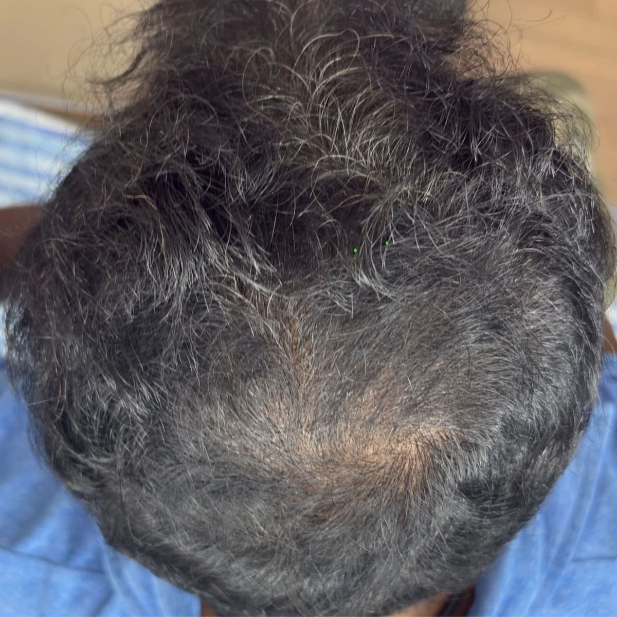Hair Loss After