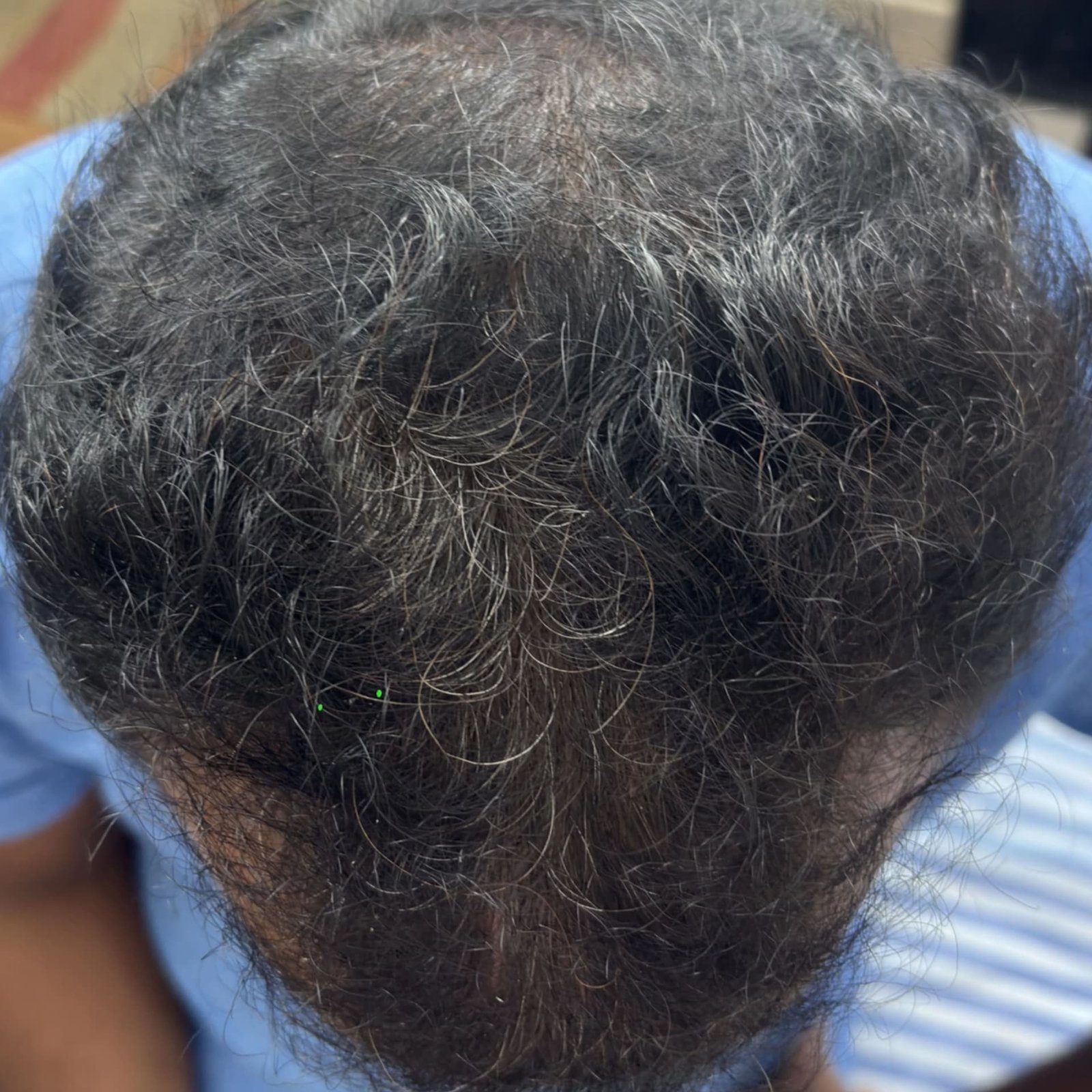 Hair Restoration Patient 2 After