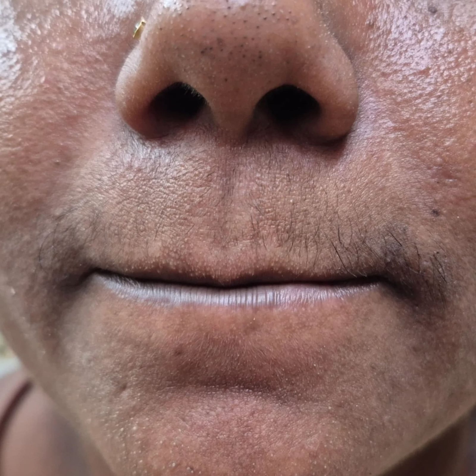 Laser Hair Removal Before