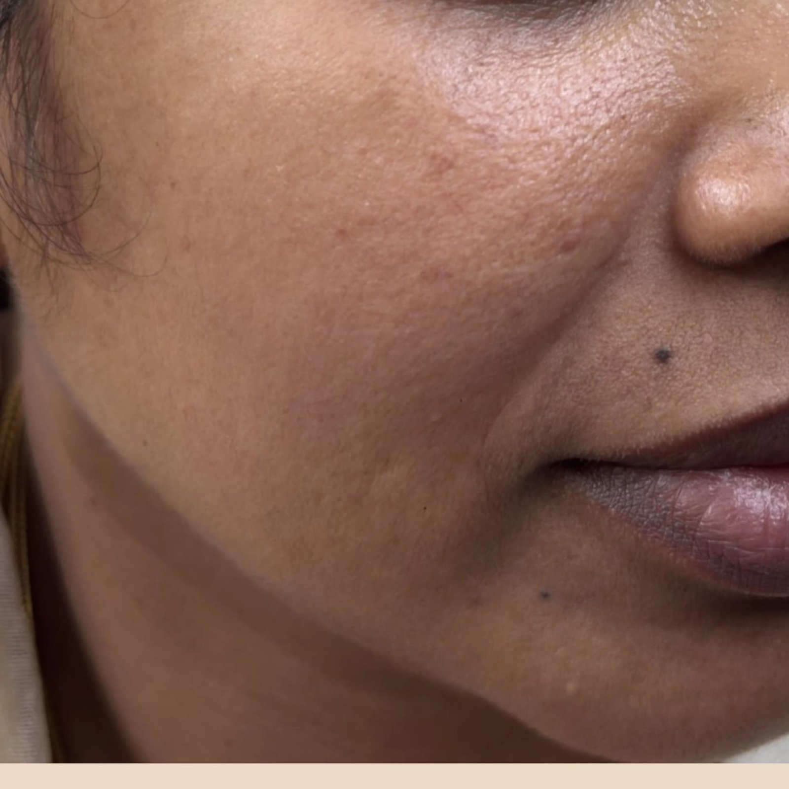 Pigmentation Patient 6 After