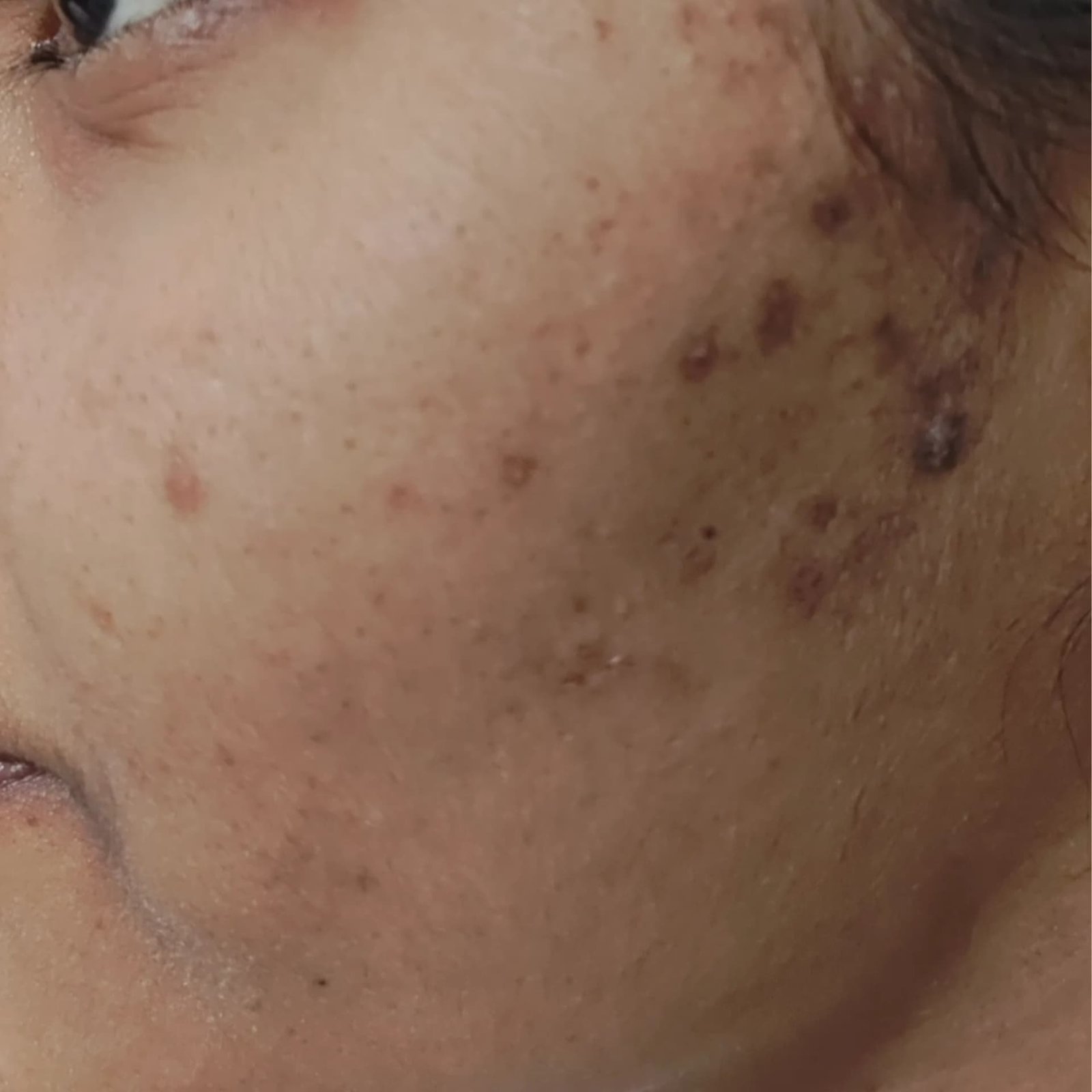 Pigmentation Patient 5 Before