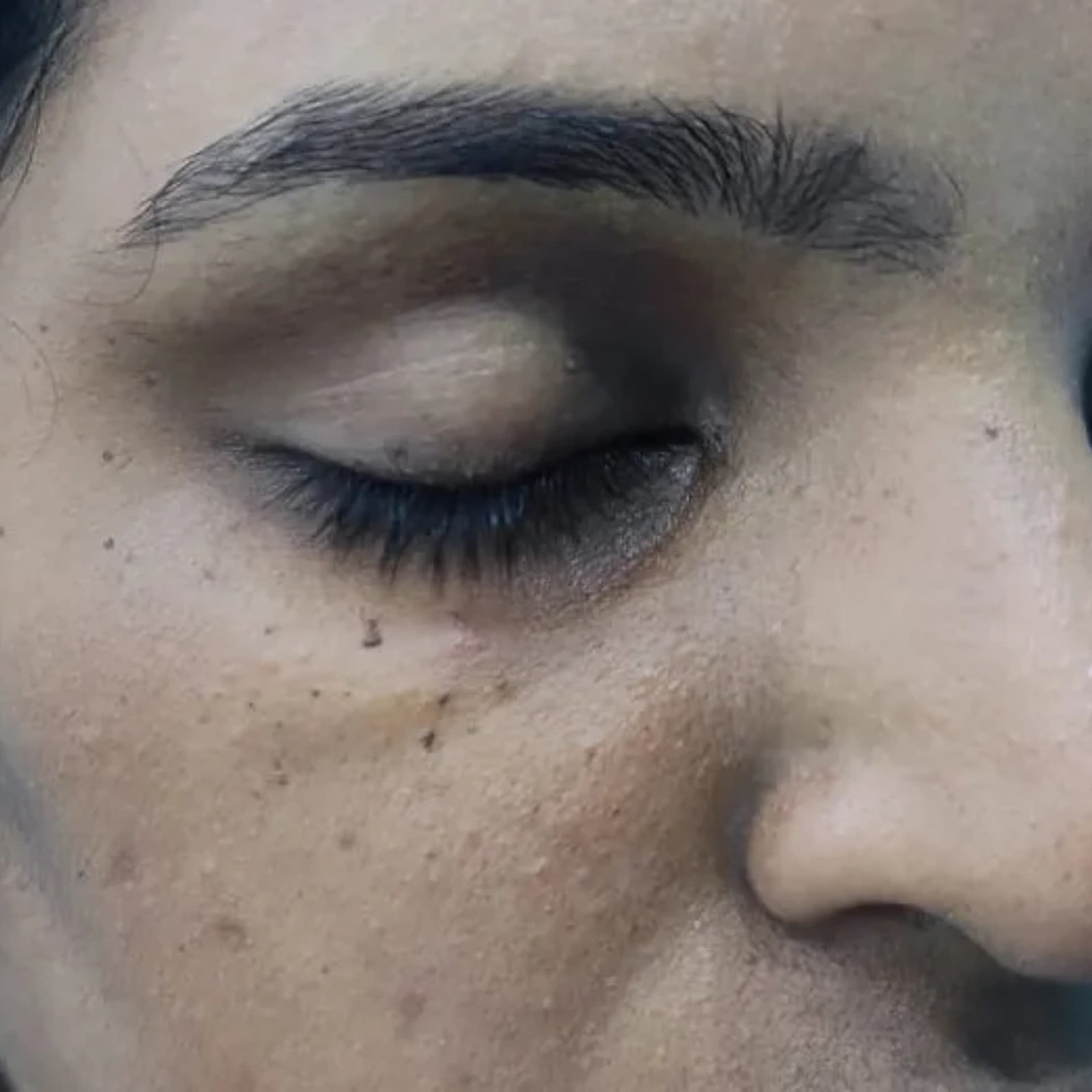 Mole Treatment Before