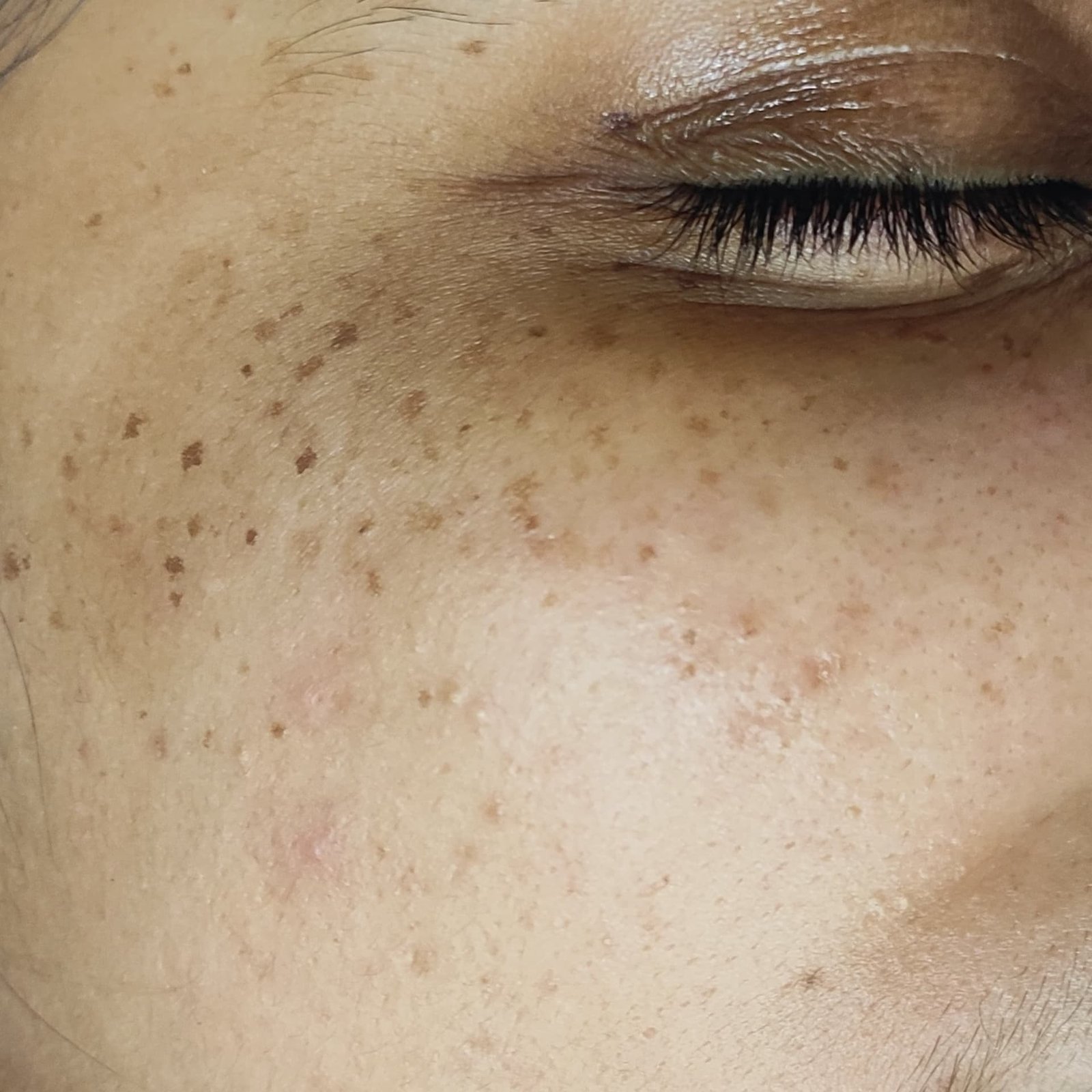 Dermal Pigmentation Before