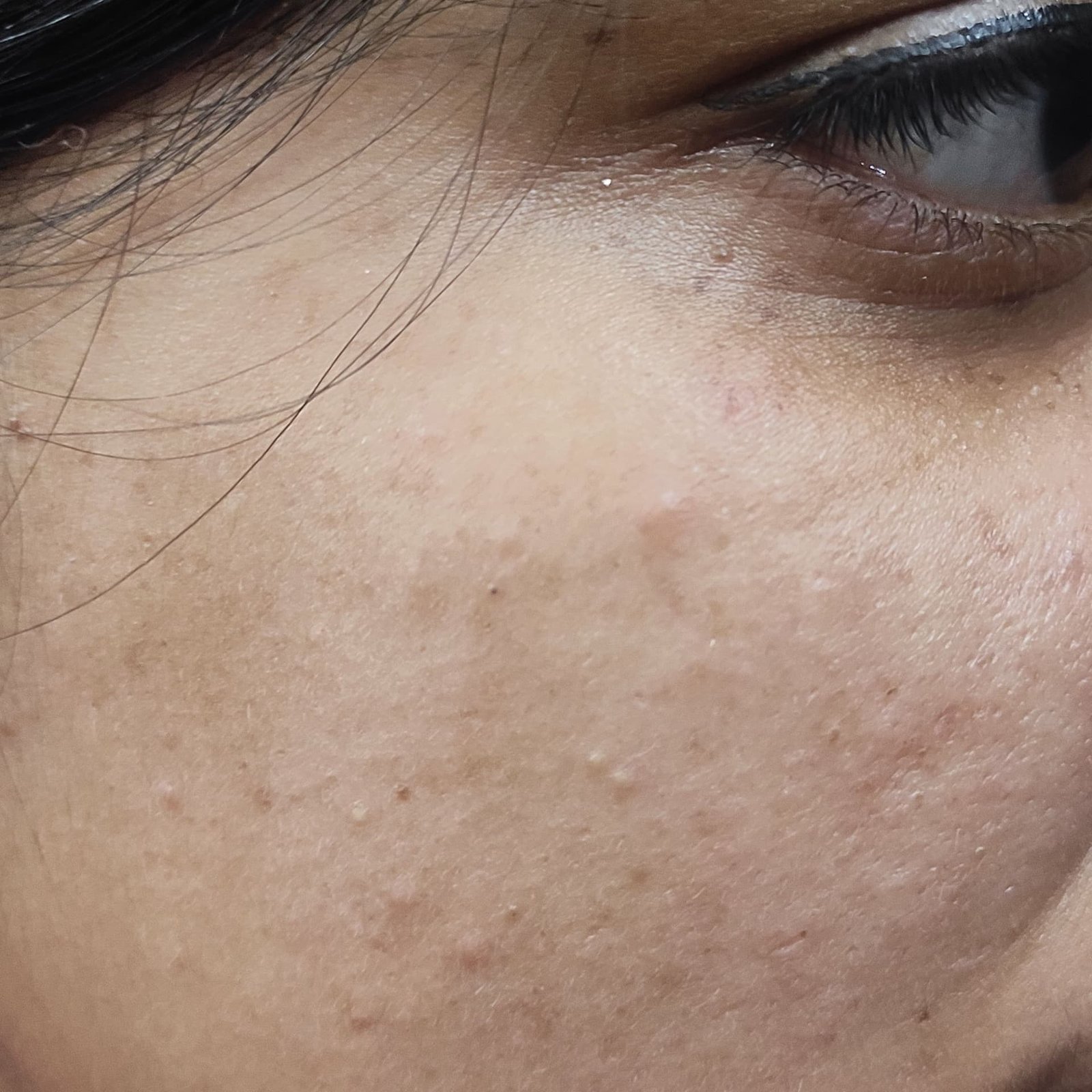 Dermal Pigmentation After