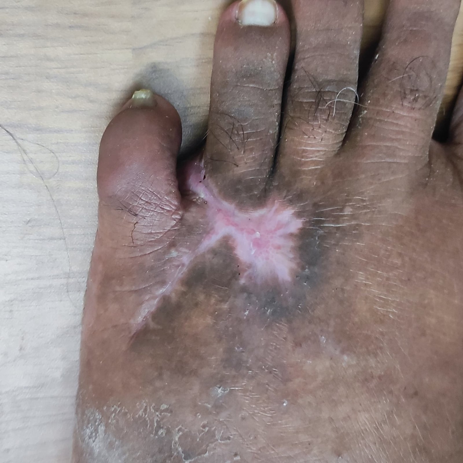 Chronic Ulcer After