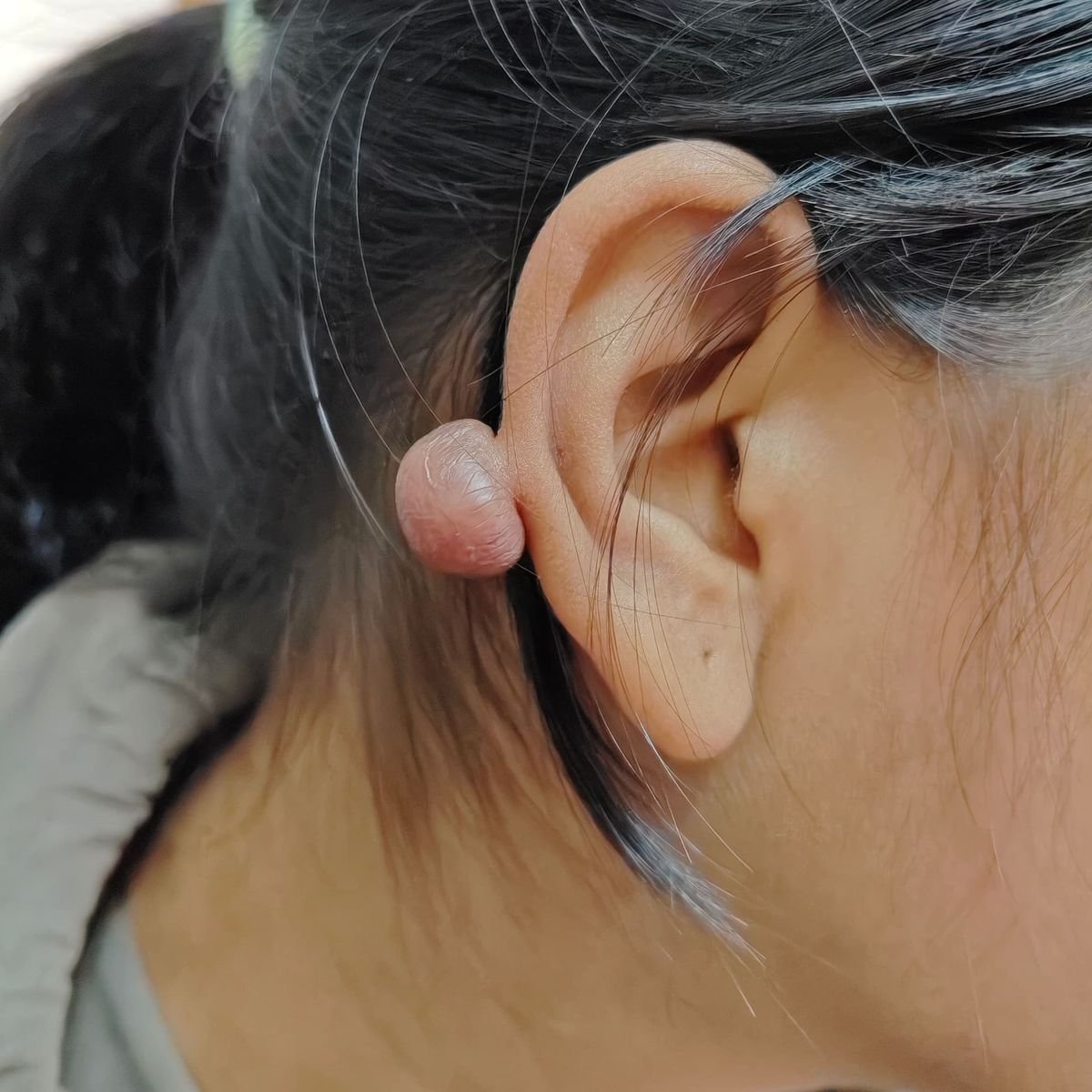 Keloid Before
