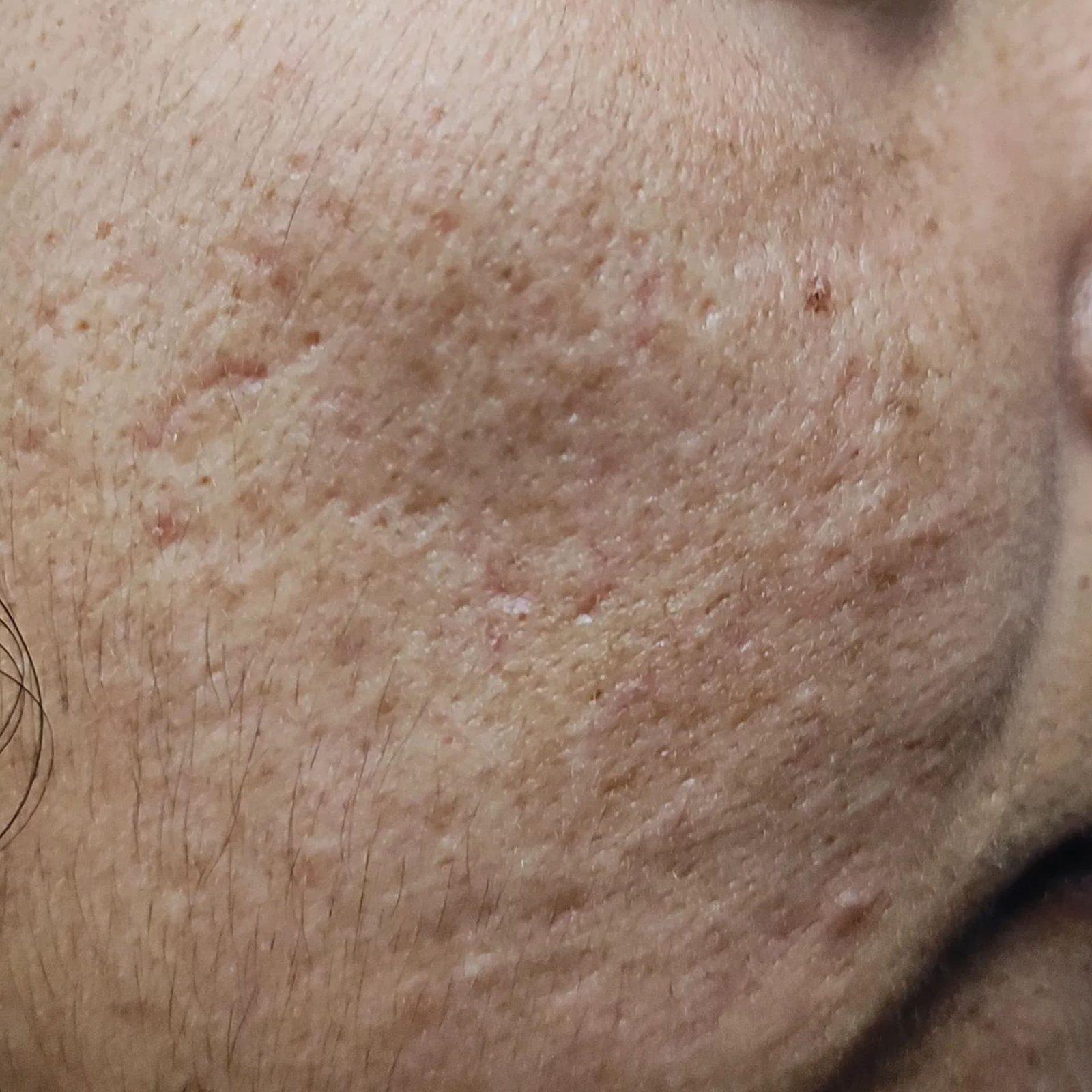 Melasma Treatment Patient 1 After
