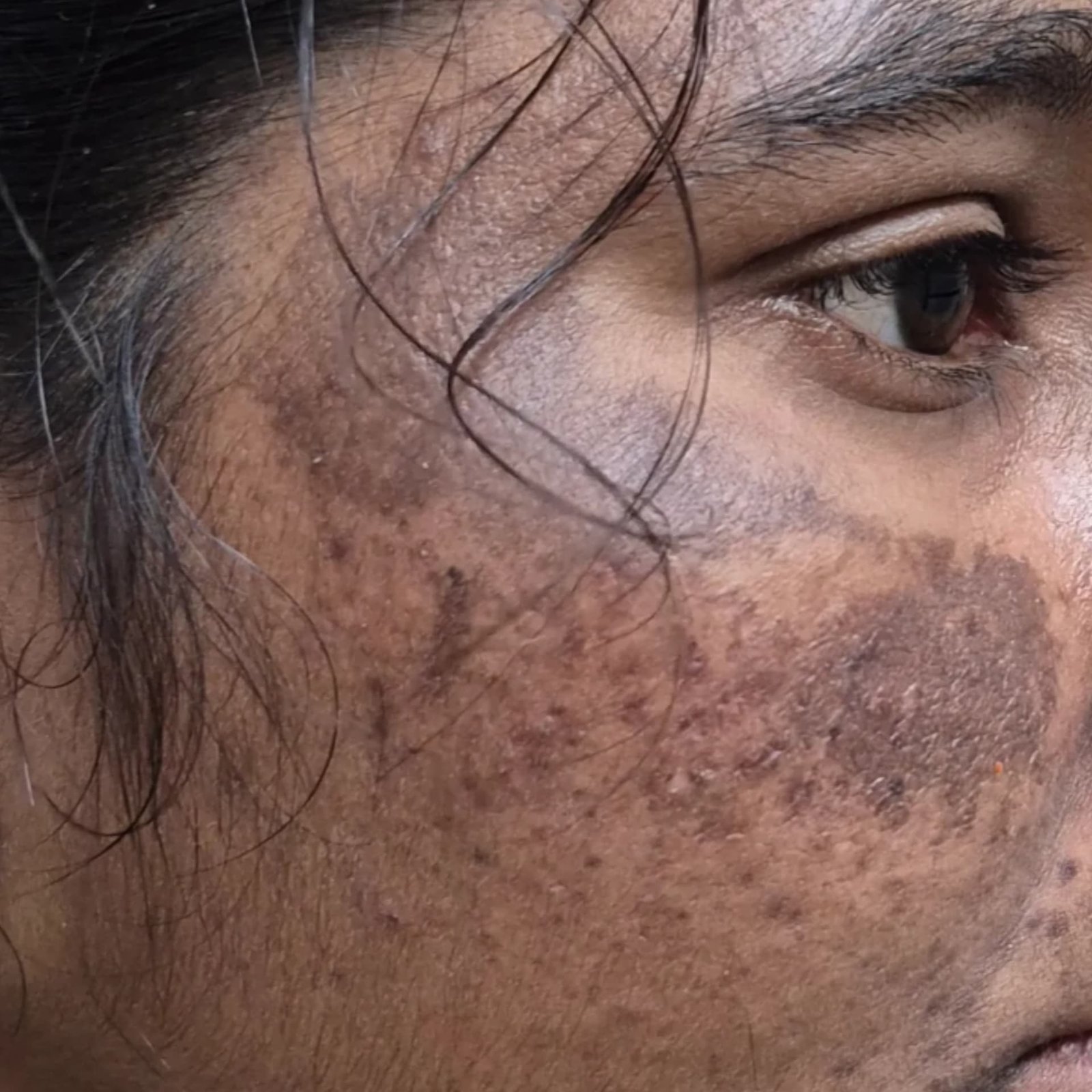 Pigmentation Patient 3 Before