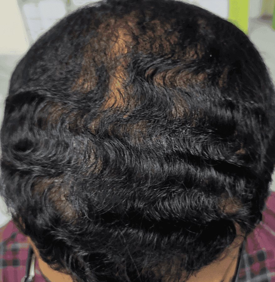 Hair Restoration Patient 5 Before