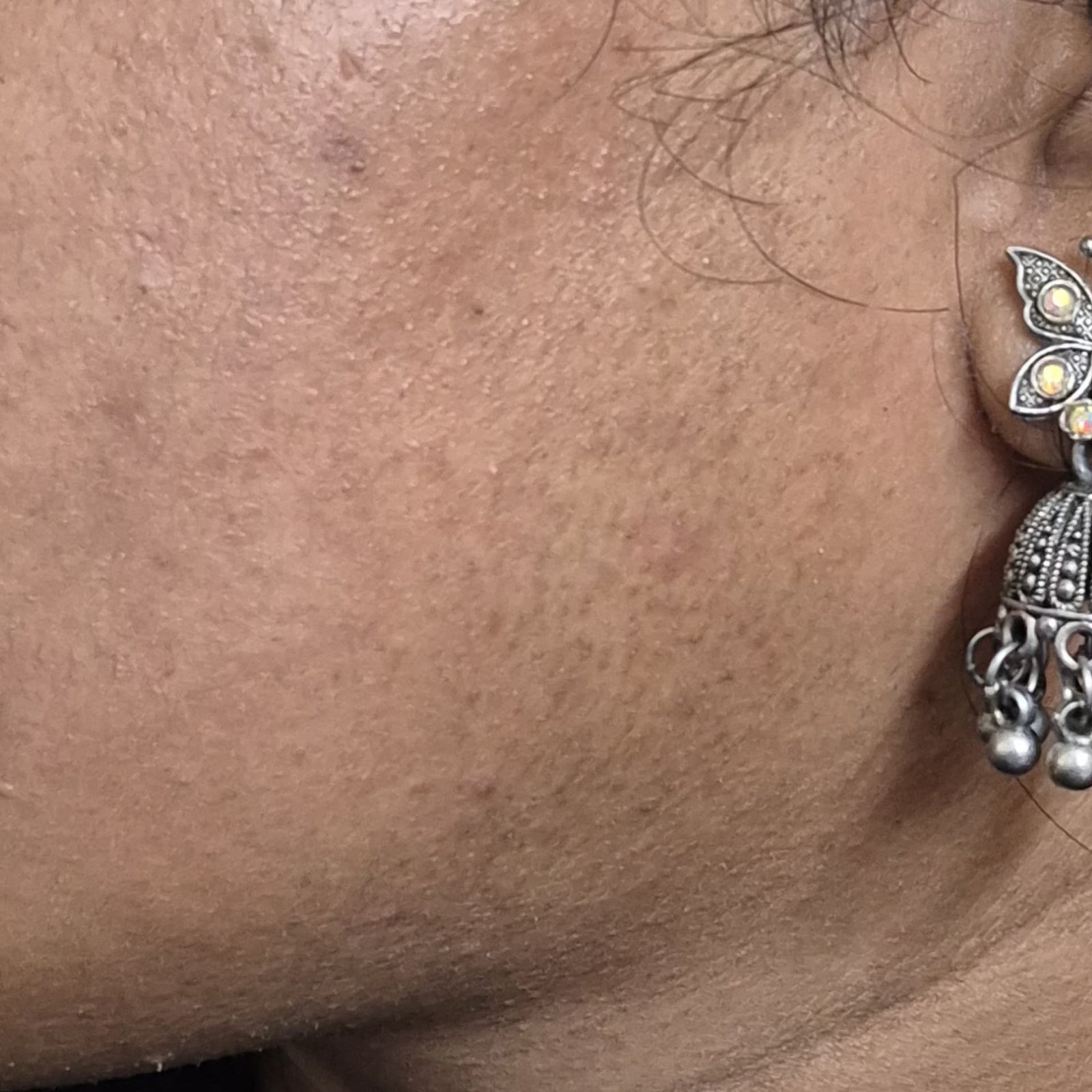 Laser Hair Removal After