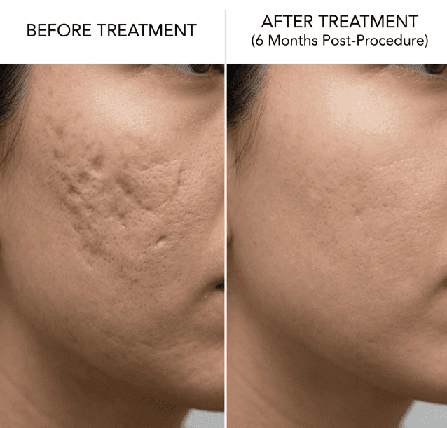 Dr. Alam Skin Clinic Acne Results