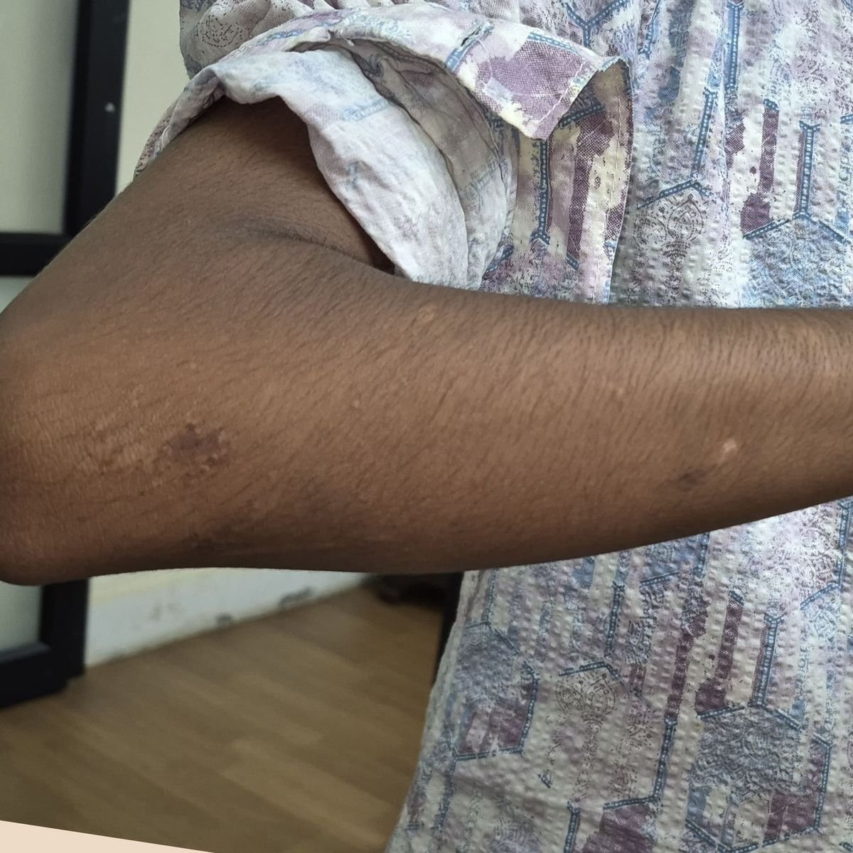 Vitiligo Patient 2 After
