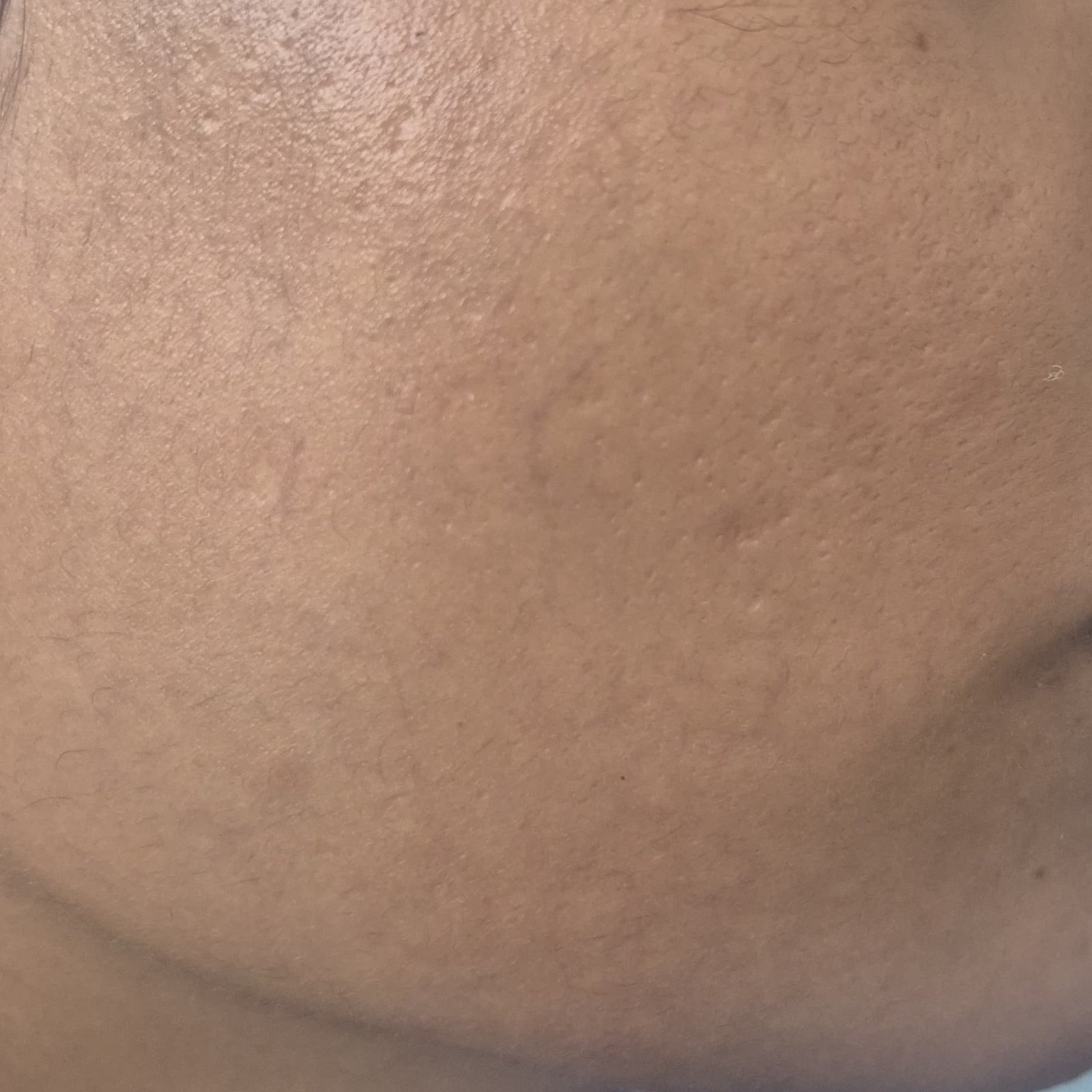 Laser After